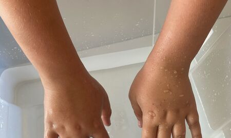 Ein Kind hat seine mit Vaseline eingeschmierten Hände in eine Plastikkiste voller Wasser getaucht und wieder herausgezogen, sodass nun Wassertropfen an der Haut abperlen